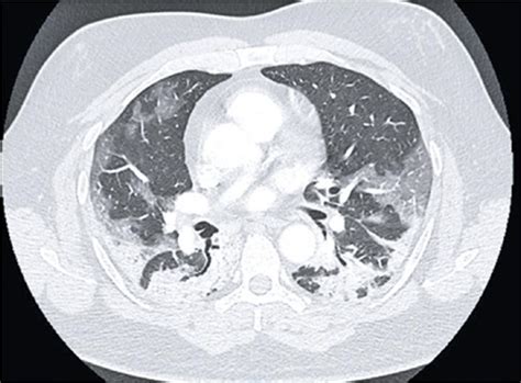 Scielo Brasil Covid 19 Findings Identified In Chest Computed