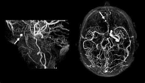 Anterior Ethmoidal Artery Aneurysm And Intracerebral Hemorrhage American Journal Of Neuroradiology