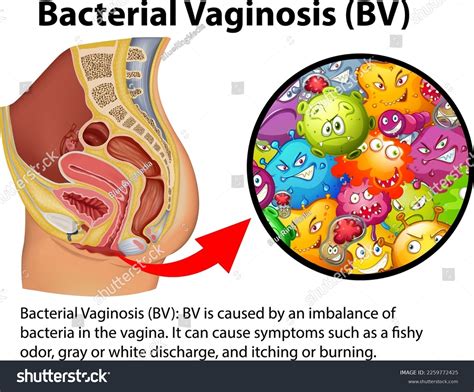 Bacterial Vaginosis Bv Infographic Explanation Illustration Stock Vector Royalty Free