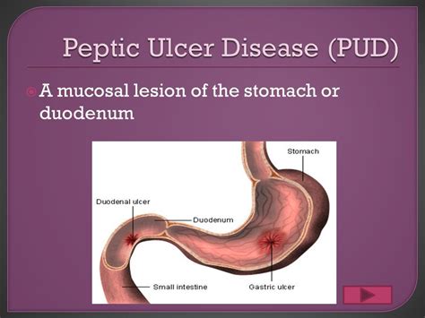 Peptic Ulcer Antibiotic Treatment