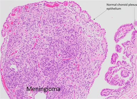 Intraventricular Meningioma Adventures In Neuropathology