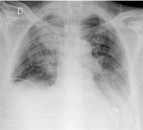 Anteroposterior Portable Chest Radiograph Obtained On Postoperative