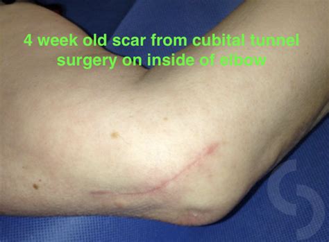 Cubital Tunnel Release Dr Edward Weldon