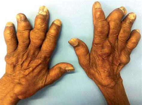 SciELO Brasil Musculoskeletal And Cutaneous Sarcoidosis Exuberant