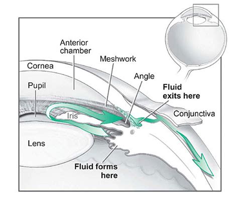 Glaucoma Nancy Coles Md Upper East Side Ophthalmologist