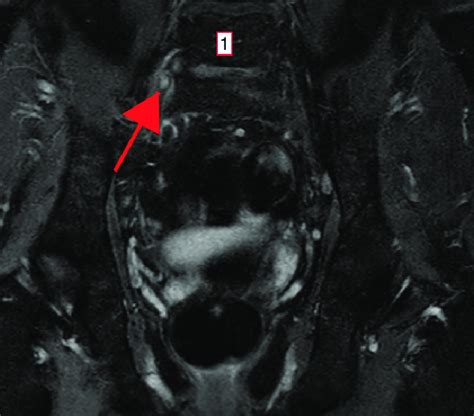 Contrast-enhanced coronal MRI demonstrating enhancement of the right L5... | Download Scientific ...