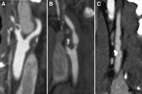 Atherosclerotic Plaque Surface Morphology In The Carotid Bifurcation