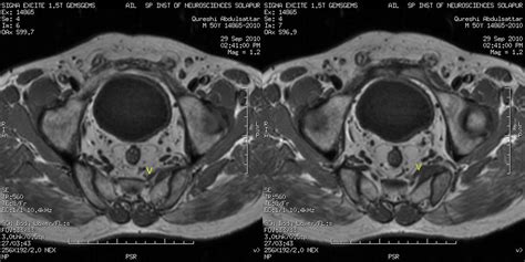 Pyriformis Syndrome Mri Piriformis Muscle Nerve Entrapment Mri