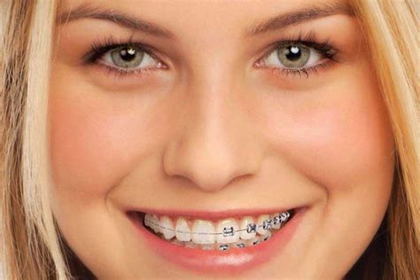 Orthodontics- Bracing for Braces - Elite Clinic