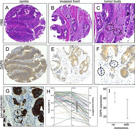 Immunohistochemical Staining Of Dapk Protein Expression In Tumors Of