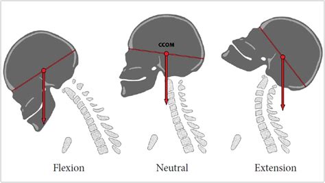 Cervical flexion and extension muscles Archives - Samarpan ...