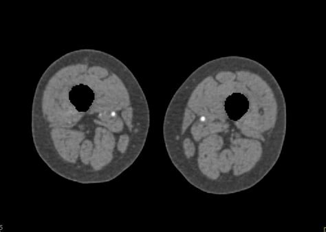 Dual Energy Ct Angiogram With Peripheral Vascular Disease In