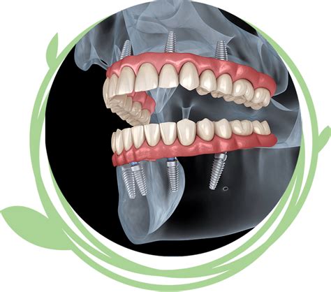 Full Mouth Dental Implants | Clovis, CA | Clovis Family Dentistry