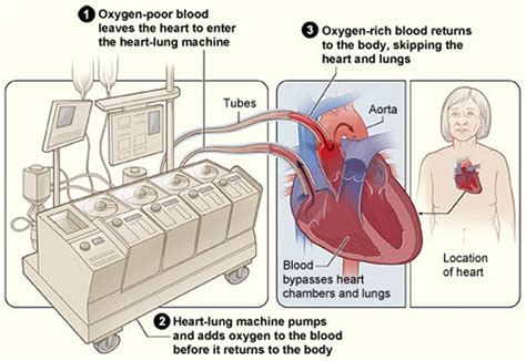 Heart Surgery Types - Open, Bypass, Ablation, Heart Valve surgery