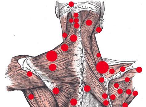 Trigger Points What Are They And How Can They Be Treated