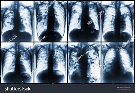 Pulmonary Tuberculosis Collection Chest Xray Show Foto De Stock