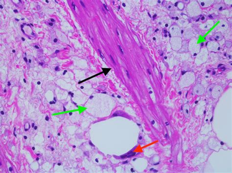 Sclerosing Mesenteritis A Rare Cause Of Abdominal Pain PMC