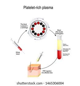 Plateletrich Plasma Prp Medical Procedure Hair Stock Vector Royalty