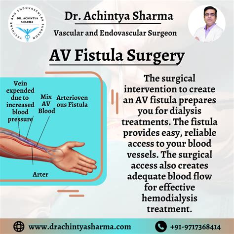 Av Fistula Surgery