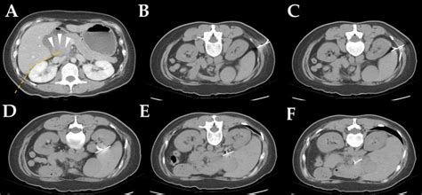 Computed Tomography Ct Guided Core Needle Biopsy Images Via Detour Download Scientific