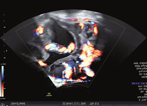 Ultrasound examination of placenta praevia percreta: on the right side ...