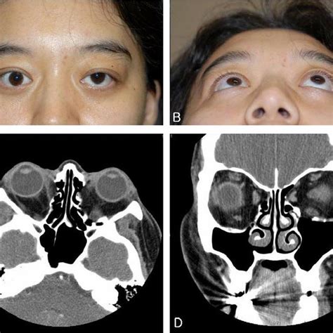 Pdf A Case Of Imploding Antrum Silent Sinus Syndrome After Orbital Decompression