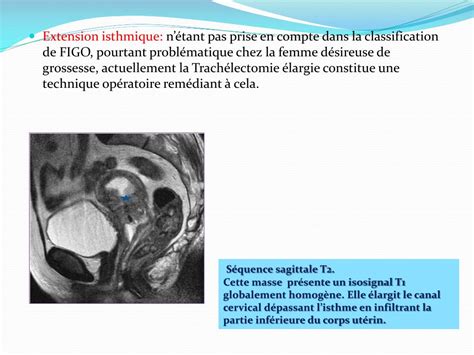 Ppt Apport De Lirm Dans Les Tumeurs Du Col Uterin Powerpoint