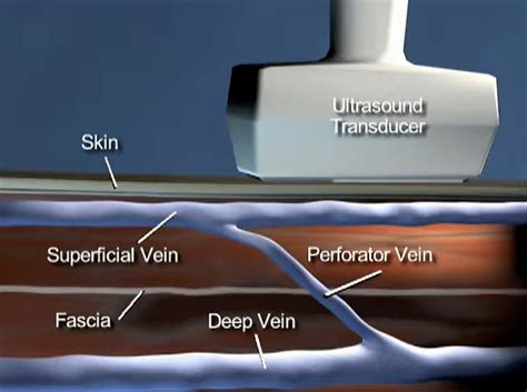 Patients Guide To Radiofrequency Perforator Ablation