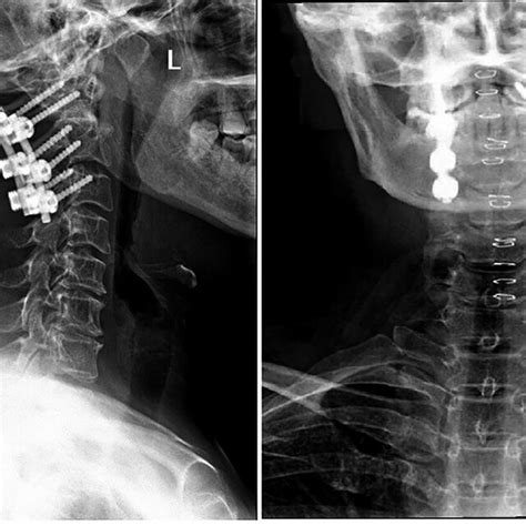 Postoperative Lateral X Ray Of Cervical Spine Download Scientific