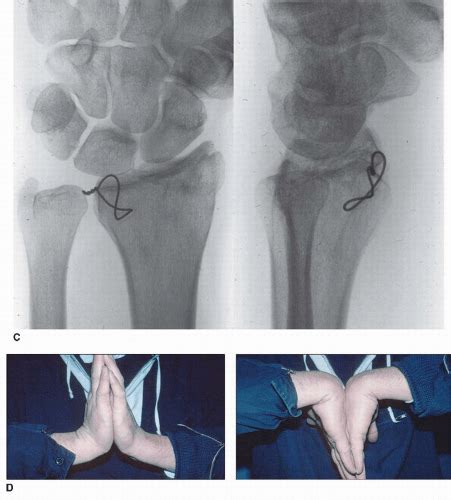 Distal Radius Fractures Open Reduction Internal Fixation Musculoskeletal Key