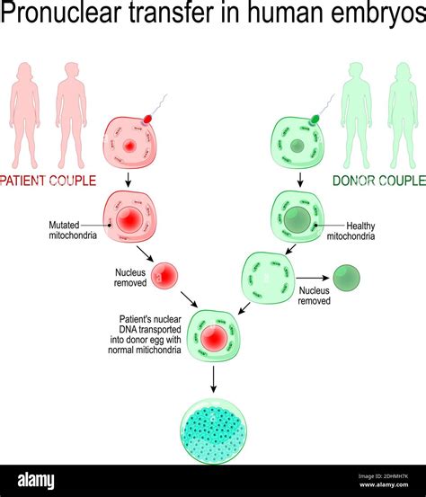 Babies Of Three Parent Inherited Mitochondrial Diseases Pronuclear