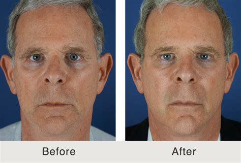 Dermal Fillers For Men Photos Charlotte NC Carolina Facial Plastics