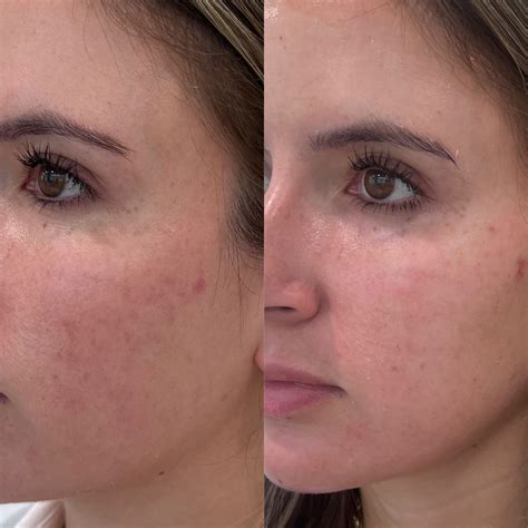 Chemical Peel Season The Perfect Derma Peel Canvas Skin