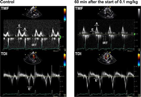 Typical Echocardiography Showing The Transmitral Flow Velocity Pattern