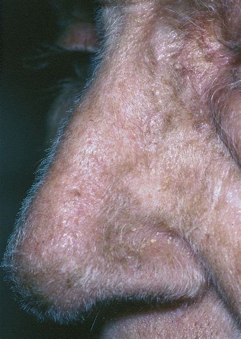 Acquired Hypertrichosis Lanuginosa As A Presenting Sign Of Metastatic