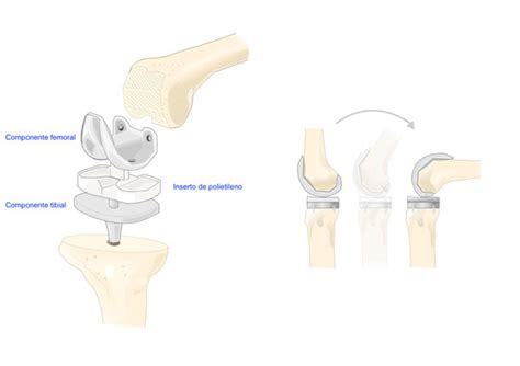 Pr Tesis De Rodilla