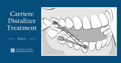 Carriere Distalizer Treatment Steps For Patients With Braces Cooney And Tyner Orthodontics