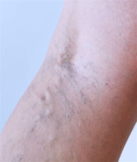 Varicose Vein Treatment Melbourne Varicose Vein Removal