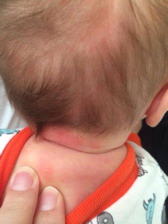 Rash or acne on back of his neck? Pic included... | BabyCenter