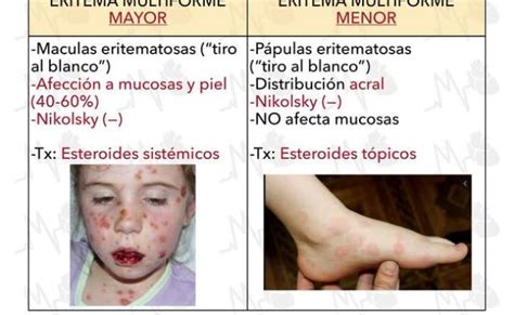 Eritema Multiforme Causas Sintomas Y Tratamiento Dr Gabriel Serrano ...