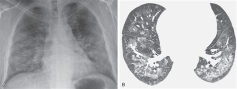 Hypersensitivity Pneumonitis Radiology Key