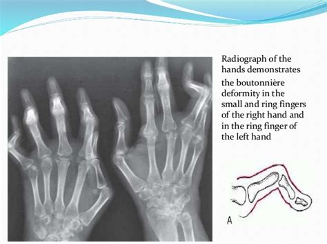 Rheumatoid Arthritis Radiologiid