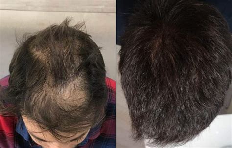 Before And After Hair Transplant Step By Step Situation Rephair