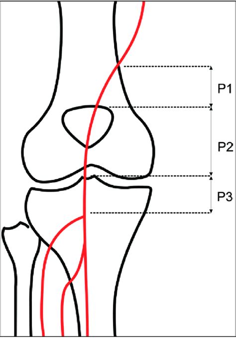 Popliteal Artery Aneurysm Peripheral Aneurysm Geeky Medics