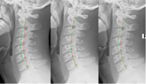 Lateral Cervical Radiographs Left Initial 1 3 18 Image Showing