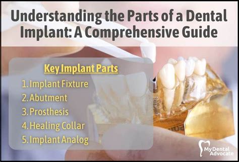 Understanding The Parts Of A Dental Implant A Comprehensive Guide