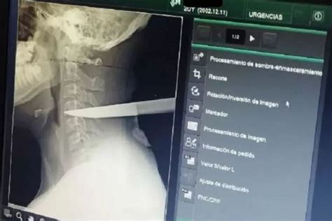 Sobrevivió Con Un Cuchillo Clavado En El Cuello Durante Varias Horas El Joven Resultó Herido