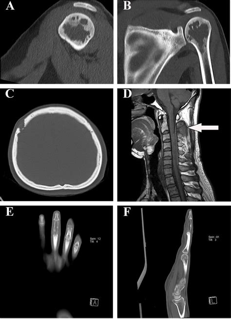 Radiographic Findings In Our Four Patients A B The Sagittal And