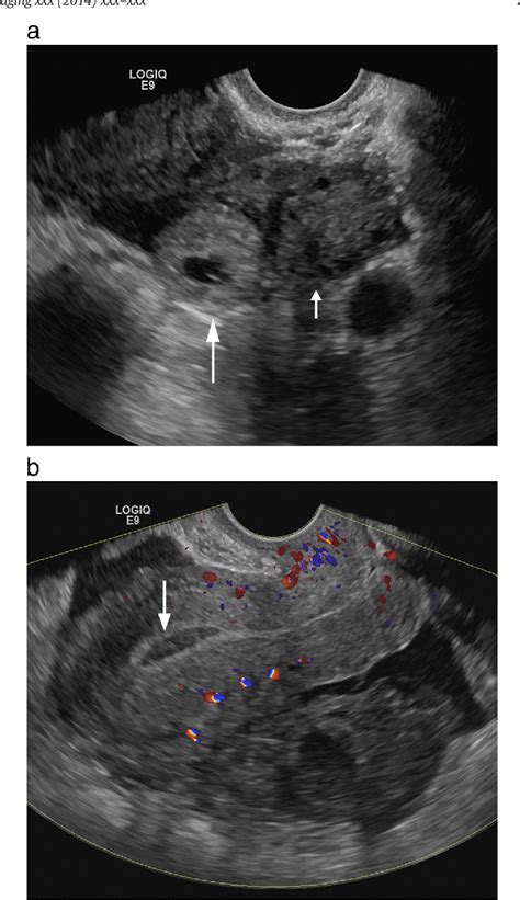 Figure 2 From Pearls And Pitfalls In First Trimester Obstetric Sonography Semantic Scholar