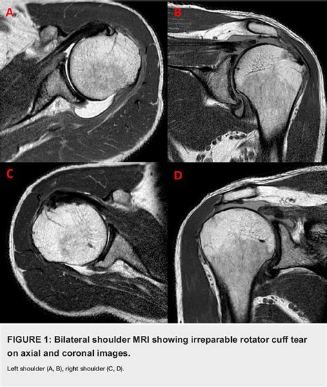 Pdf Bilateral Arthroscopic Superior Capsular Reconstruction Of The